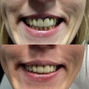 Zabieg "gummy smile"
